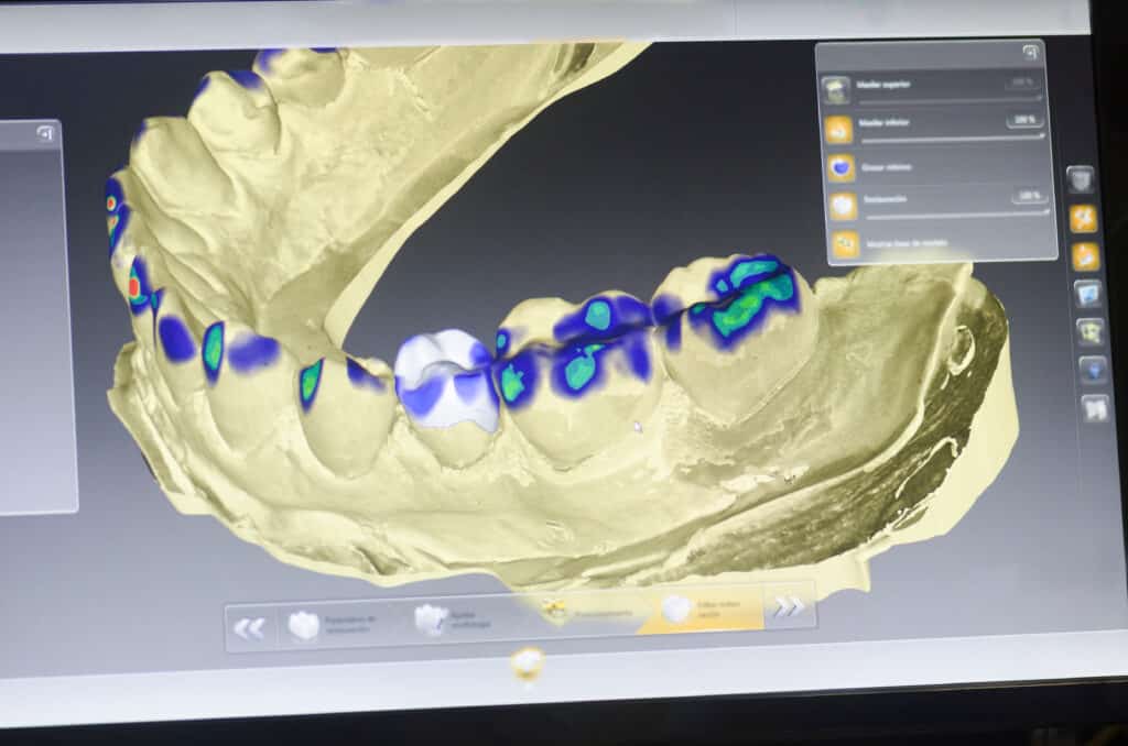 Dental Implants