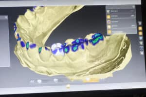 Dental Implants